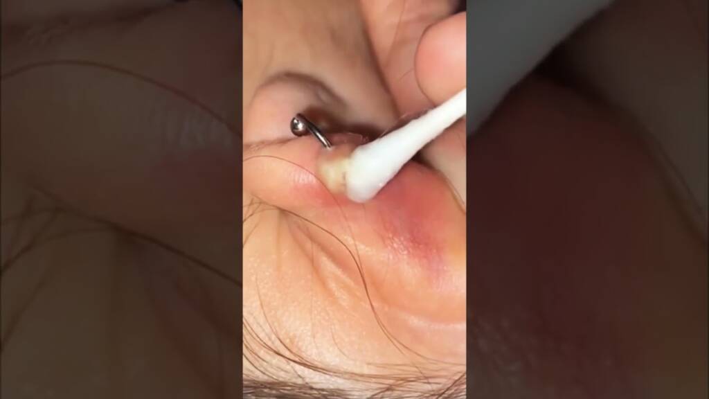 Ear Piercing Infection Hack #acnetreatment #skincare #pimplepopping #infection #piercing #shorts