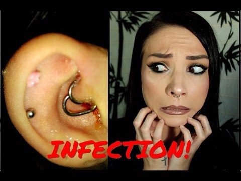 Daith-Piercing-Infektion | Wie ich es geheilt habe (MIT BILDERN)
