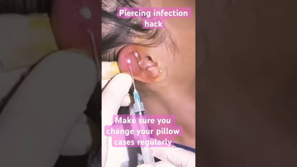 Ear Piercing Infection Hack #skincare #pimplepopping #infection #piercing #shorts #trending